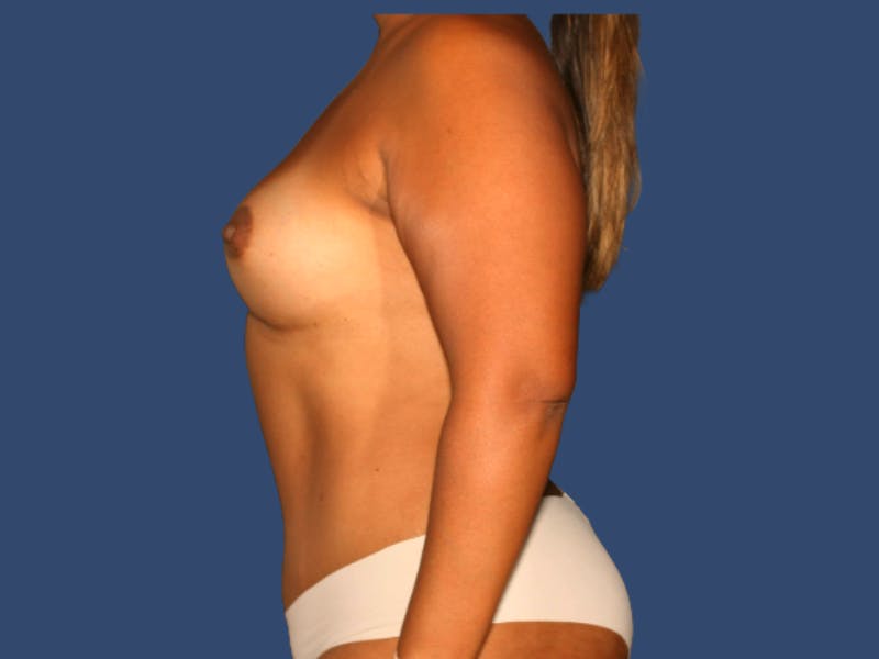Breast Augmentation Before & After Gallery - Patient 331055 - Image 4