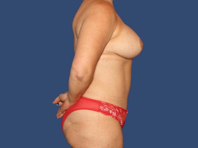 Breast Lift with Augmentation Before & After Gallery - Patient 396776 - Image 4