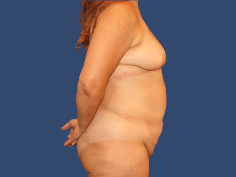 Breast Lift with Augmentation Before & After Gallery - Patient 396776 - Image 3