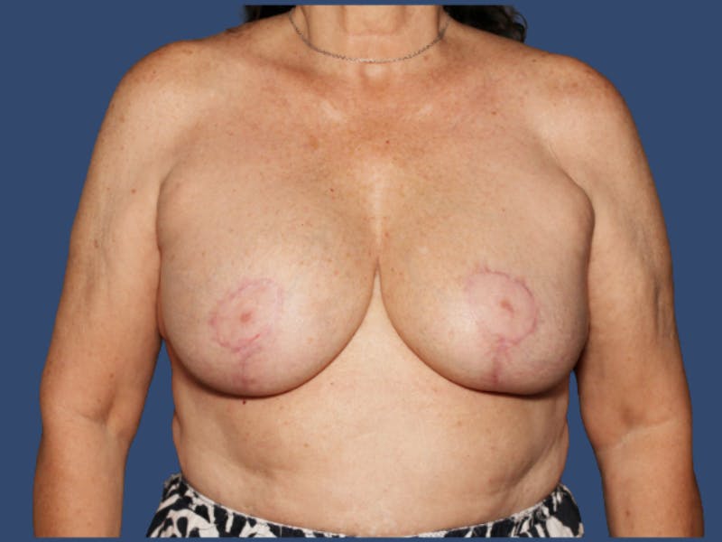 Breast Revision Before & After Gallery - Patient 107968 - Image 2