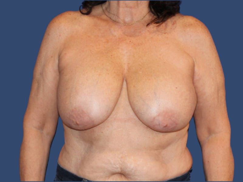 Breast Revision Before & After Gallery - Patient 107968 - Image 1