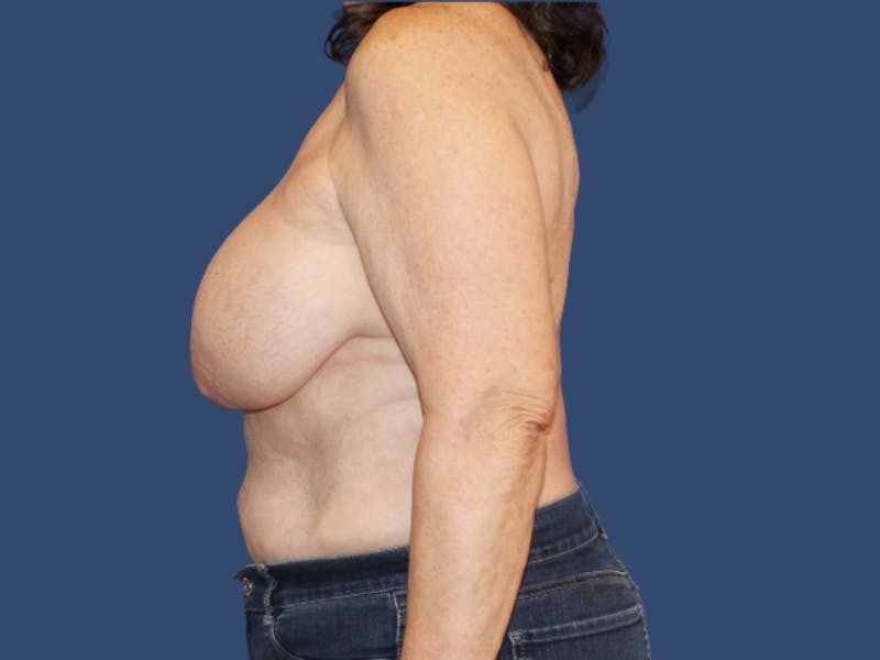Breast Revision Before & After Gallery - Patient 107968 - Image 3
