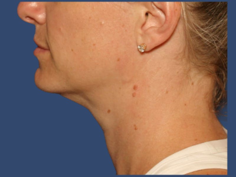 Liposuction Before & After Gallery - Patient 194566 - Image 2