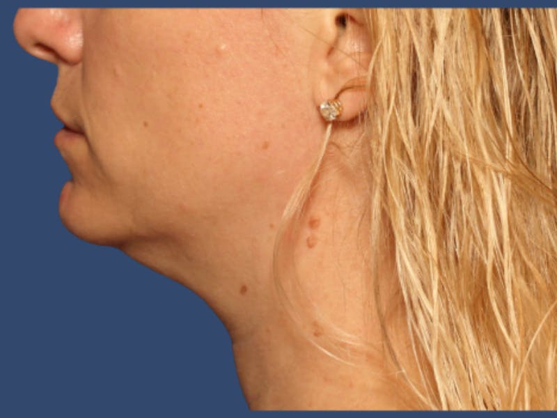 Liposuction Before & After Gallery - Patient 194566 - Image 1