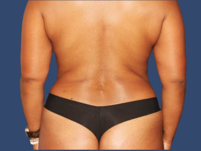 Liposuction Before & After Gallery - Patient 261644 - Image 2