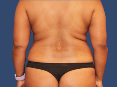 Liposuction Before & After Gallery - Patient 261644 - Image 1