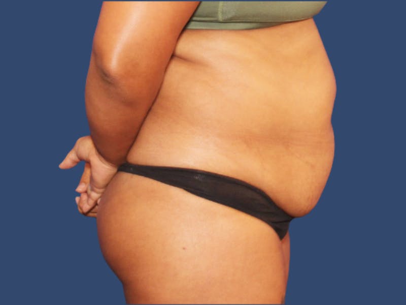 Tummy Tuck Before & After Gallery - Patient 390872 - Image 3
