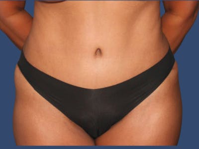 Tummy Tuck Before & After Gallery - Patient 390872 - Image 2
