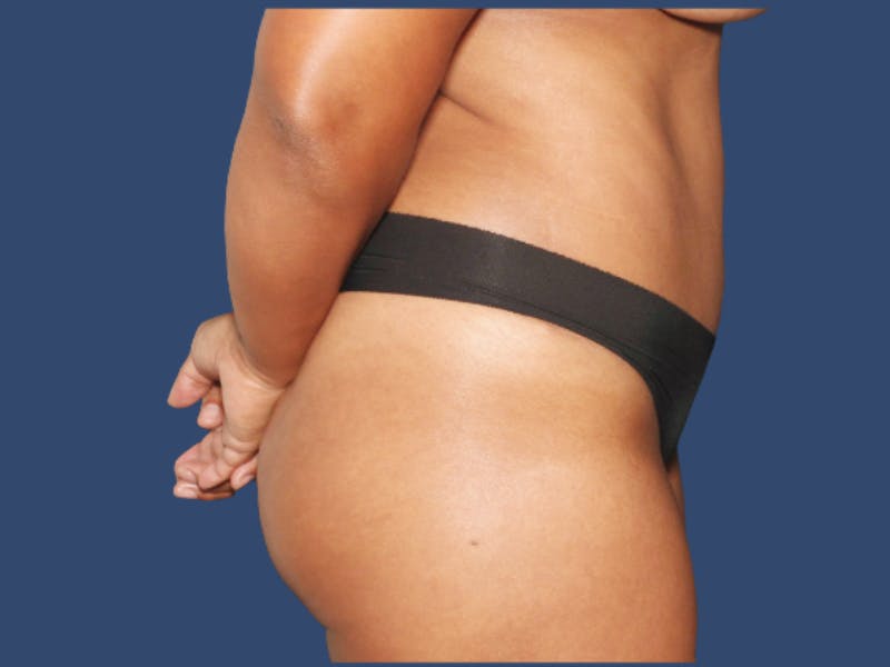 Tummy Tuck Before & After Gallery - Patient 390872 - Image 4