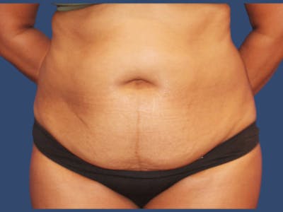 Tummy Tuck Before & After Gallery - Patient 390872 - Image 1