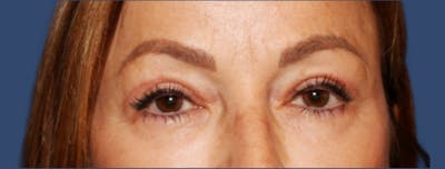 Eyelid Surgery Before & After Gallery - Patient 218016 - Image 2