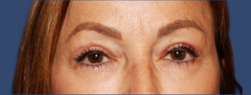 Eyelid Surgery Before & After Gallery - Patient 218016 - Image 2