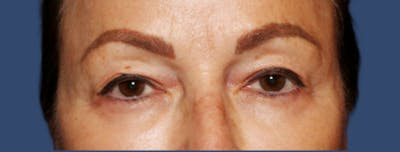 Eyelid Surgery Before & After Gallery - Patient 218016 - Image 1
