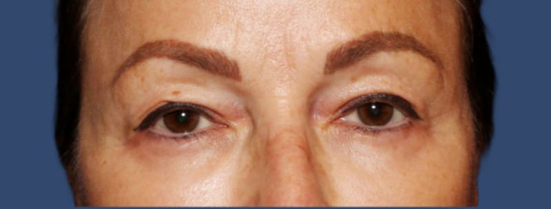 Eyelid Surgery Before & After Gallery - Patient 218016 - Image 1