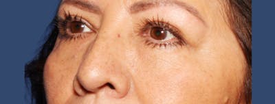 Eyelid Surgery Before & After Gallery - Patient 270887 - Image 2