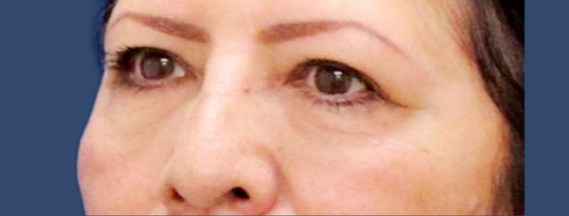 Eyelid Surgery Before & After Gallery - Patient 270887 - Image 1