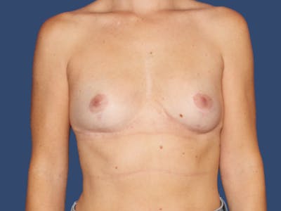 Breast Lift Before & After Gallery - Patient 189012 - Image 2