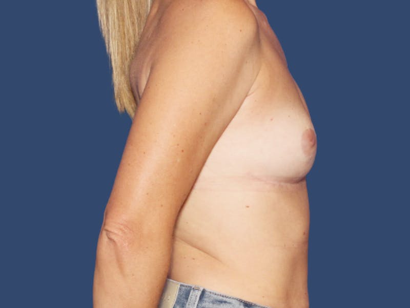 Breast Lift Before & After Gallery - Patient 189012 - Image 4