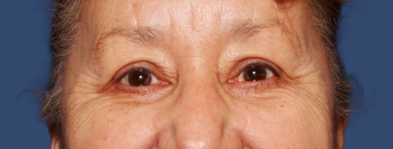 Eyelid Surgery Before & After Gallery - Patient 365539 - Image 2