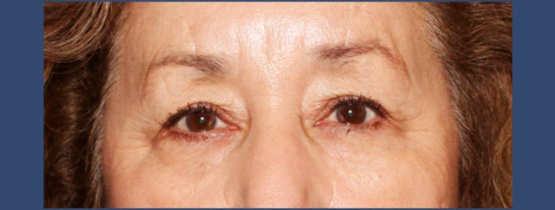 Eyelid Surgery Before & After Gallery - Patient 365539 - Image 1