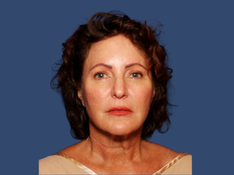 Neck Lift Before & After Gallery - Patient 220514 - Image 1