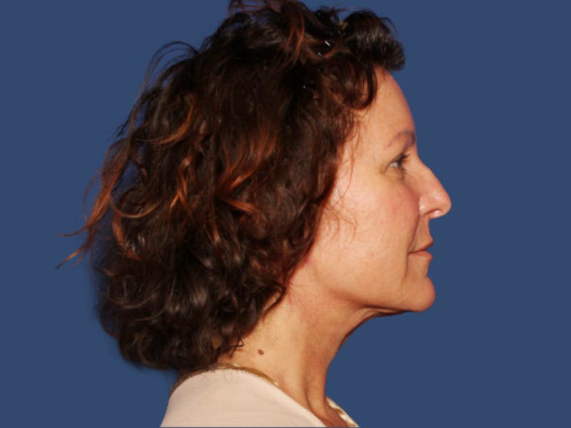 Neck Lift Before & After Gallery - Patient 220514 - Image 4