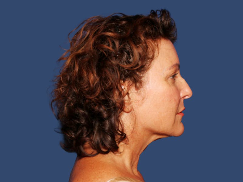 Neck Lift Before & After Gallery - Patient 220514 - Image 3