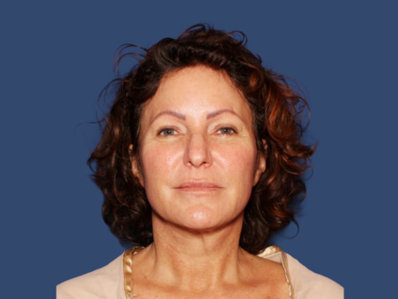 Neck Lift Before & After Gallery - Patient 220514 - Image 2