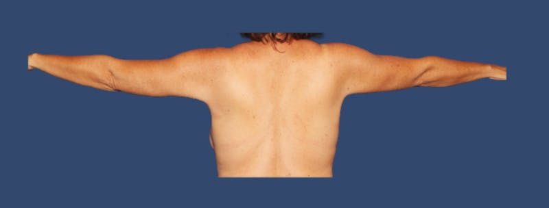 Arm Lift Before & After Gallery - Patient 196309 - Image 2