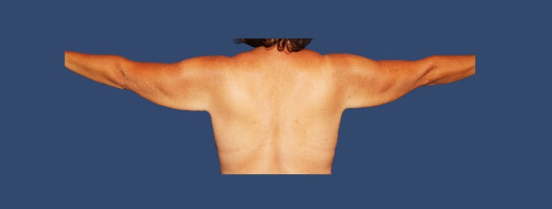 Arm Lift Before & After Gallery - Patient 196309 - Image 1