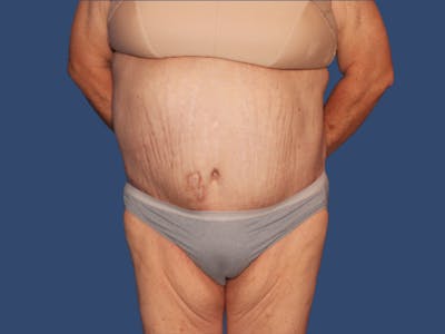 Tummy Tuck Before & After Gallery - Patient 249379 - Image 2
