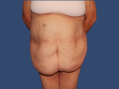 Tummy Tuck Before & After Gallery - Patient 249379 - Image 1