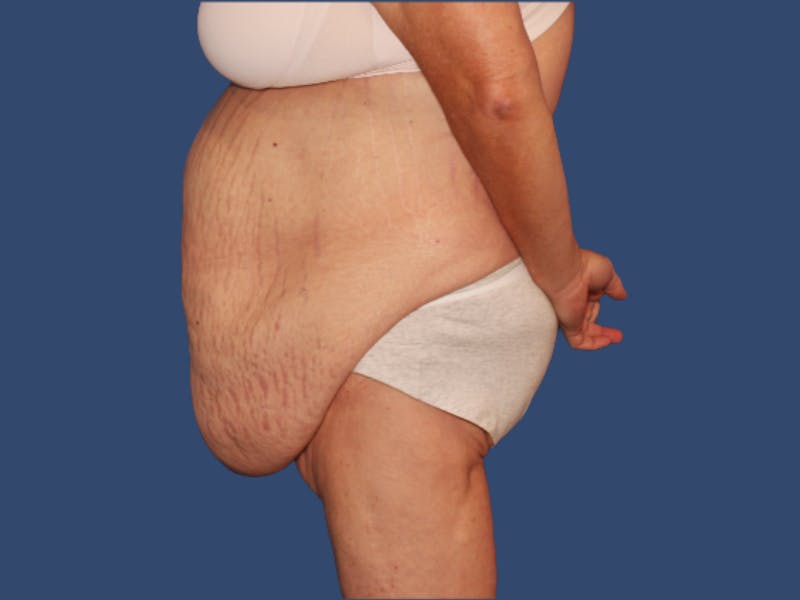 Tummy Tuck Before & After Gallery - Patient 249379 - Image 3