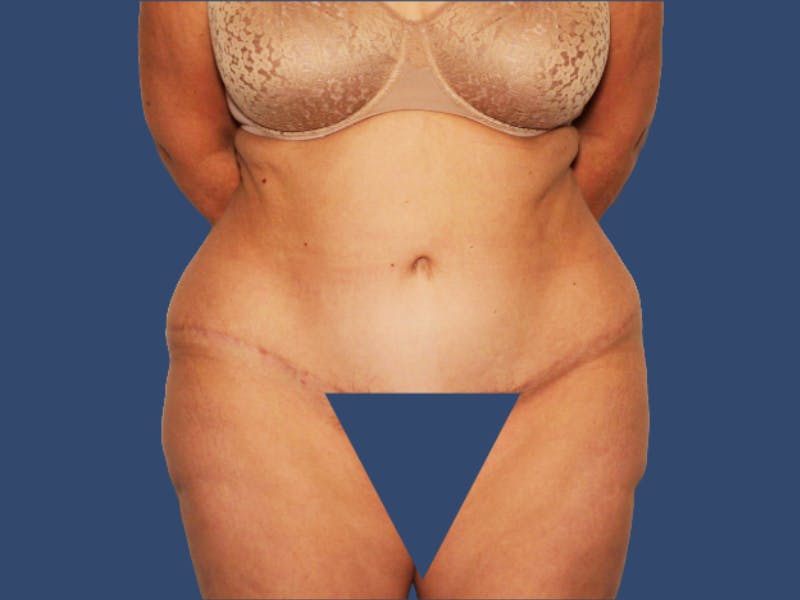 Tummy Tuck Before & After Gallery - Patient 473046 - Image 2
