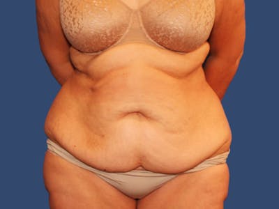 Tummy Tuck Before & After Gallery - Patient 473046 - Image 1