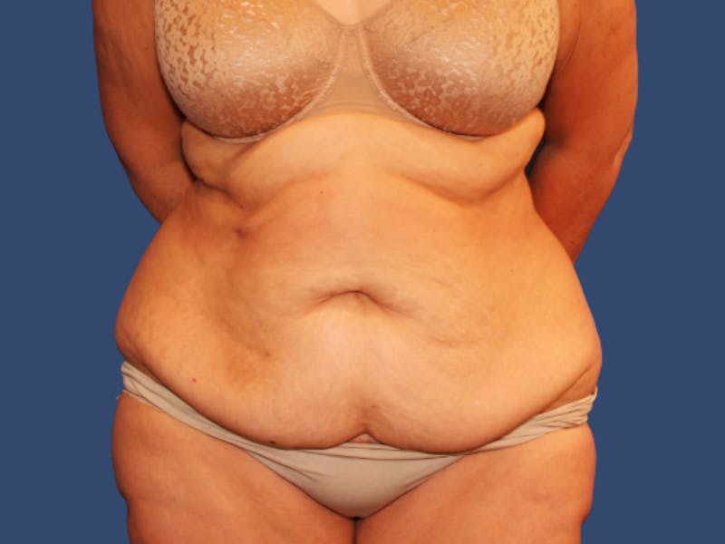 Tummy Tuck Before & After Gallery - Patient 473046 - Image 1