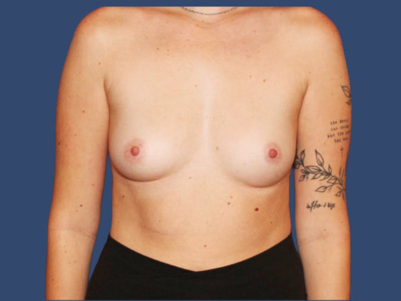 Breast Augmentation Before & After Gallery - Patient 172273 - Image 1