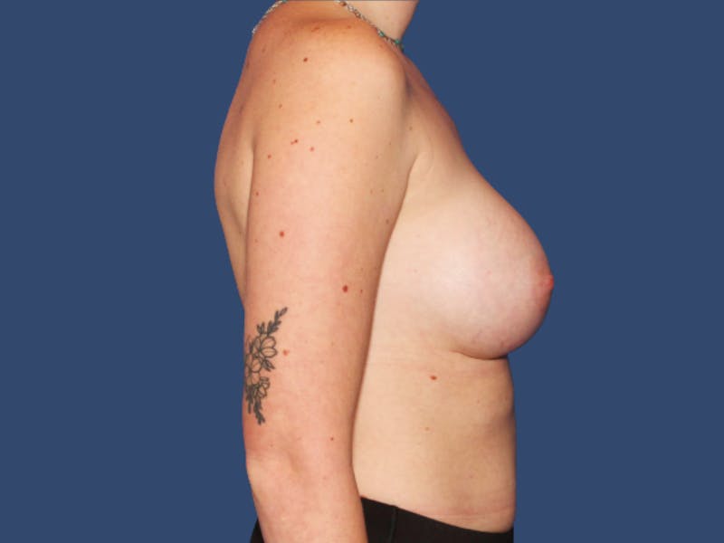 Breast Augmentation Before & After Gallery - Patient 172273 - Image 4
