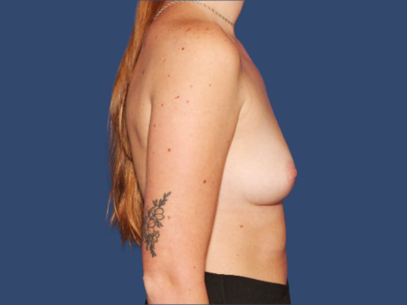 Breast Augmentation Before & After Gallery - Patient 172273 - Image 3