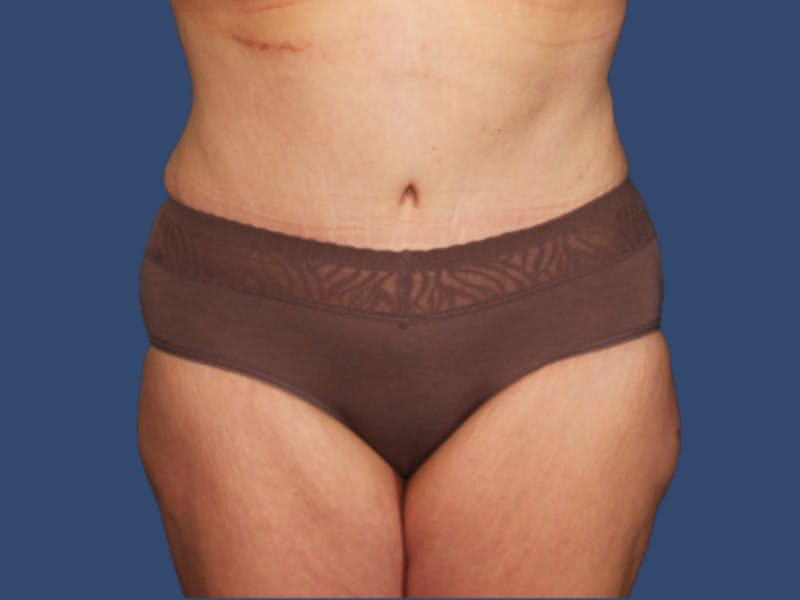 Tummy Tuck Before & After Gallery - Patient 391874 - Image 2