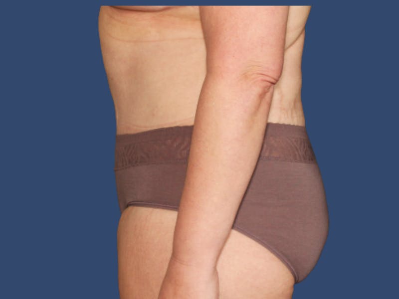 Tummy Tuck Before & After Gallery - Patient 391874 - Image 4