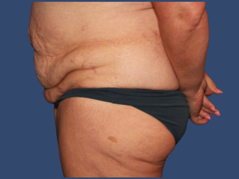 Tummy Tuck Before & After Gallery - Patient 391874 - Image 3