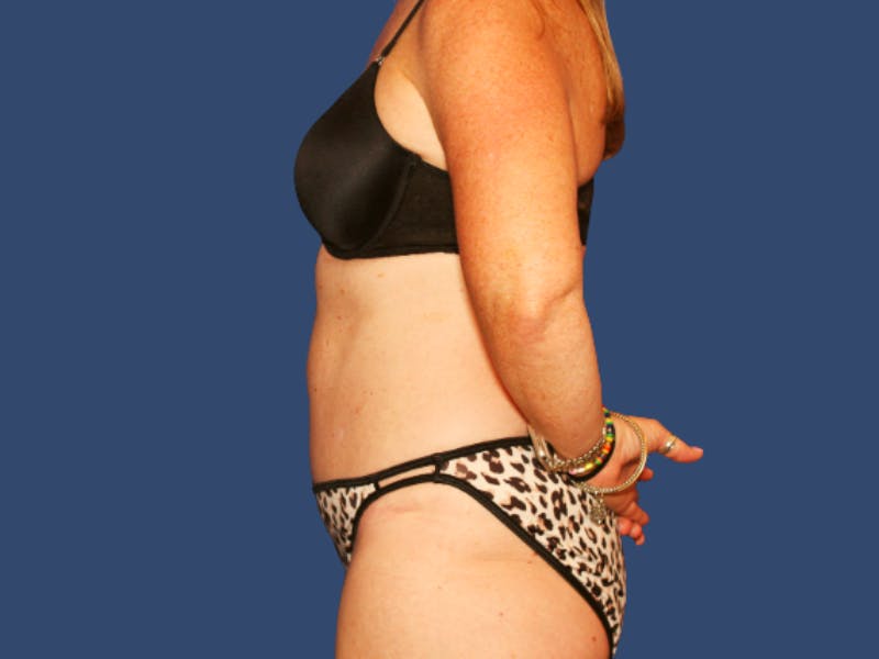 Tummy Tuck Before & After Gallery - Patient 262845 - Image 4