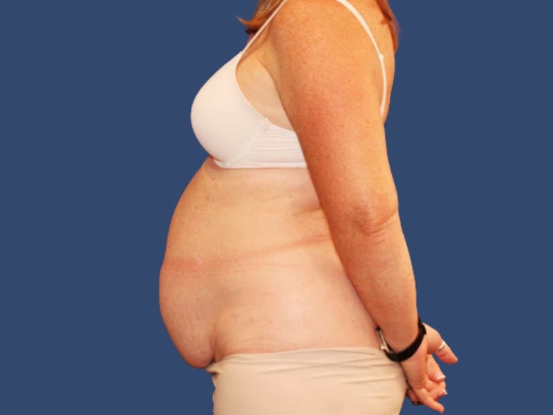 Tummy Tuck Before & After Gallery - Patient 262845 - Image 3