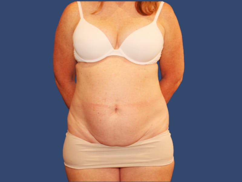 Tummy Tuck Before & After Gallery - Patient 262845 - Image 1