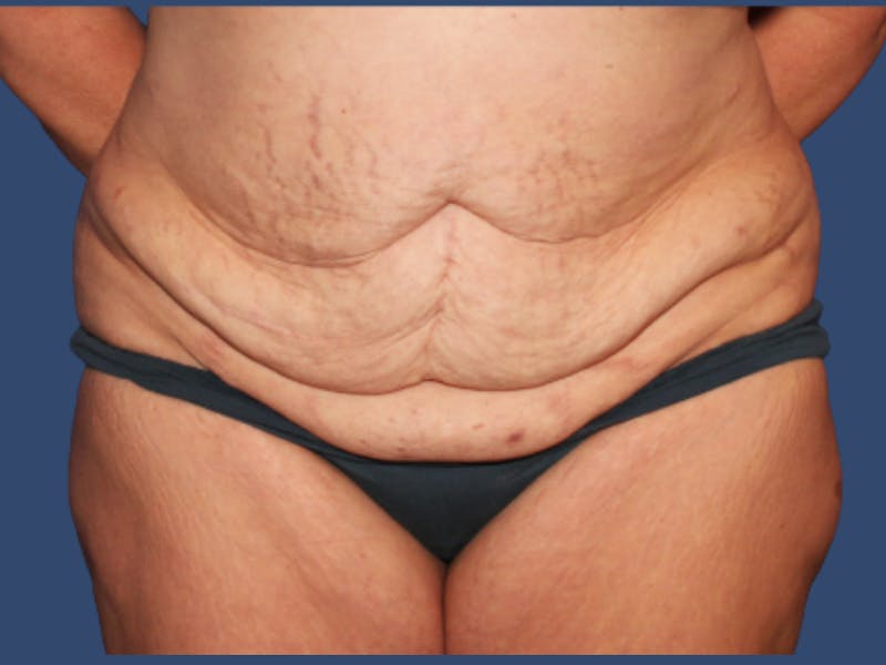 Tummy Tuck Before & After Gallery - Patient 391874 - Image 1