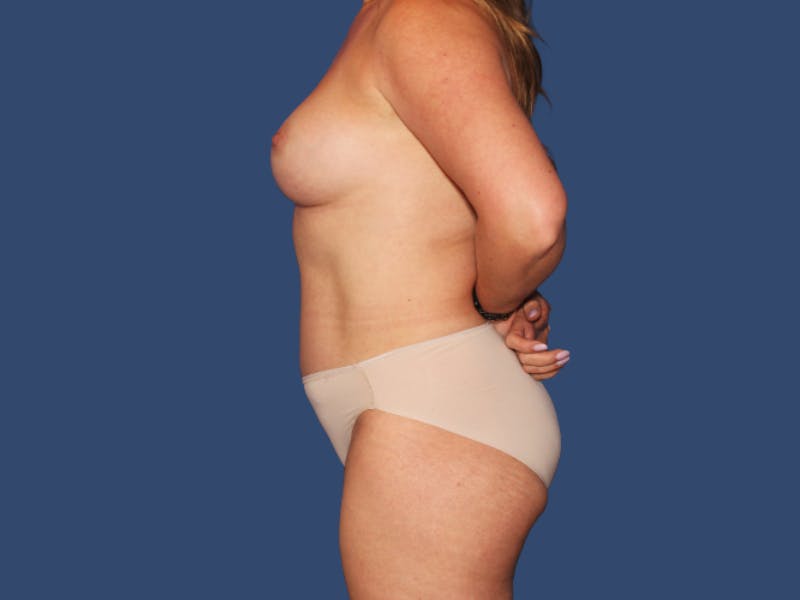 Breast Augmentation Before & After Gallery - Patient 219715 - Image 4