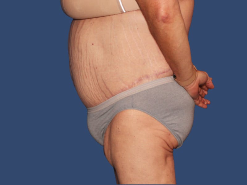 Tummy Tuck Before & After Gallery - Patient 249379 - Image 4