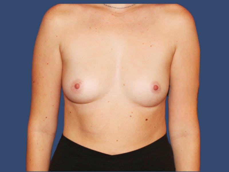 Breast Augmentation Before & After Gallery - Patient 172273 - Image 1