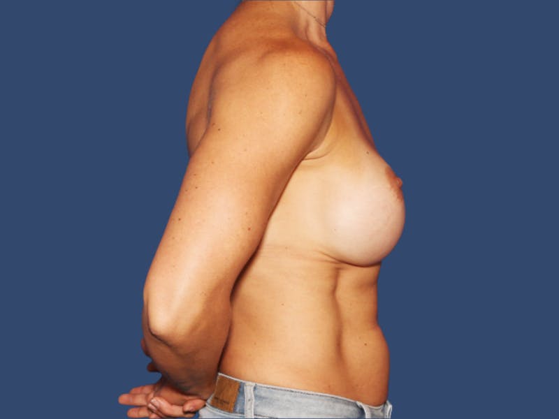 Breast Revision Before & After Gallery - Patient 420370 - Image 3
